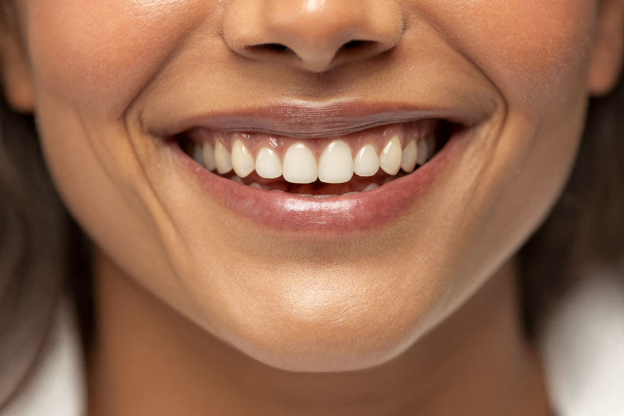 Resultado de ortodoncia invisible en paciente de Clínica Dental Sonrise Lima
